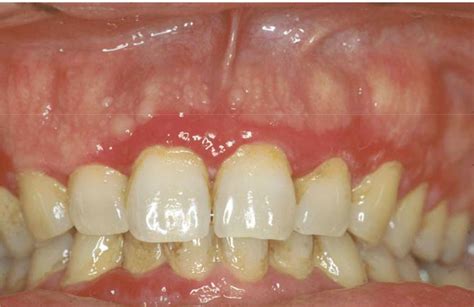 Oral Lichen Planus Gingiva