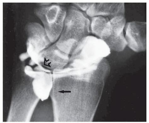 36+ Wrist Arthrogram Tfcc Tear Pics | Luther vandross, Luther series ...