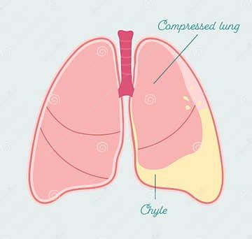 Chylothorax in Human Lung. Accumulation of Lymph in Pleural Space - Vector Anatomical Scheme ...