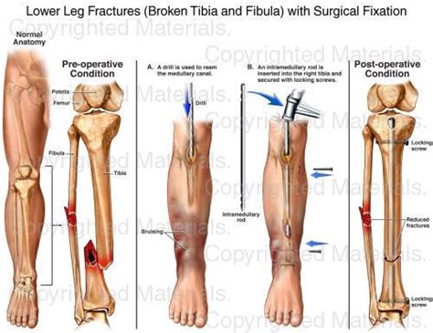 Lower Leg Fractures (Broken Tibia and Fibula) with Surgical Fixation Ankle Fracture Recovery ...