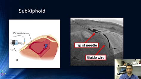 Emergent pericardiocentesis: step-by-step - Perwaiz Meraj, MD - YouTube