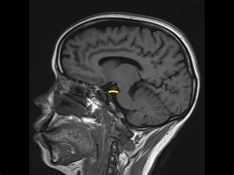 Trigeminal neuralgia | Image | Radiopaedia.org