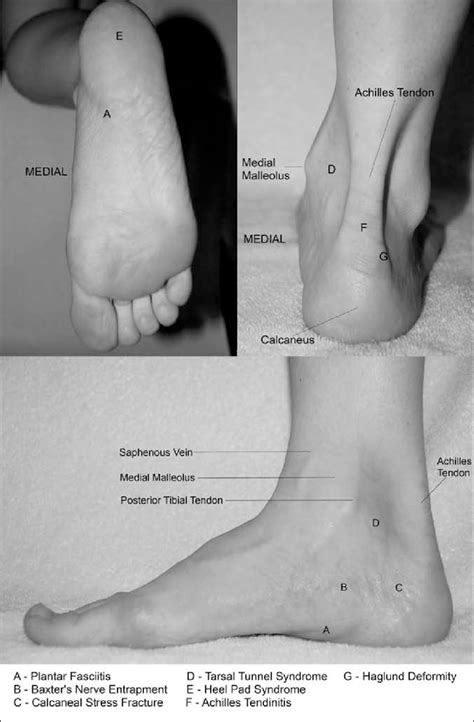 Heel pain anatomy. | Download Scientific Diagram