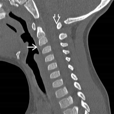 Normal Variant | Radiology Key