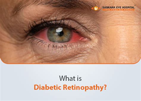 Diabetic Retinopathy Eye Problems | Sankara Eye Foundation