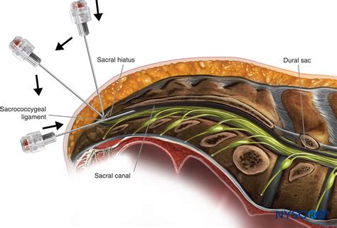 Caudal Anesthesia - NYSORA