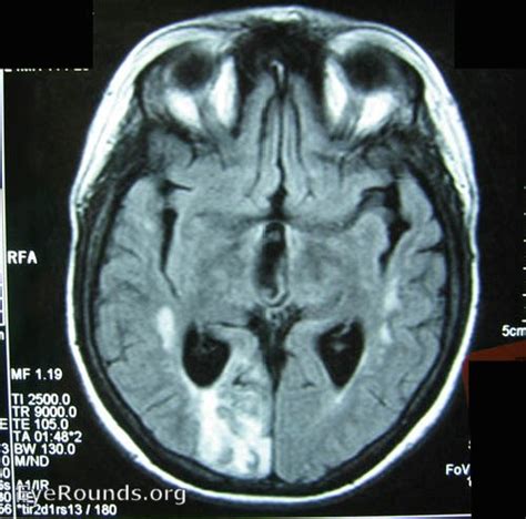 Atlas Entry - Left homonymous hemianopsia, occipital stroke