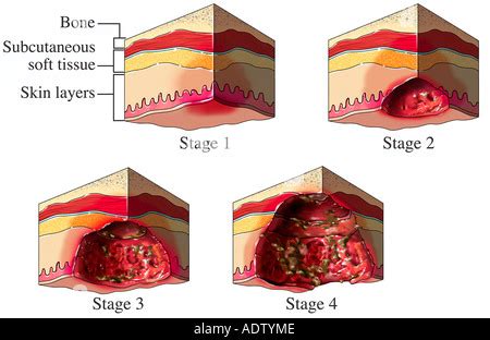 Stages of pressure sores Stock Photo: 49341605 - Alamy