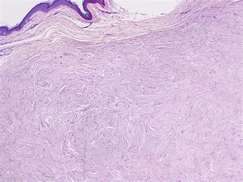 Giant Cell Fibroma Histology