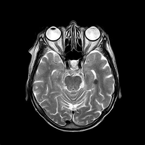 New MRI technique can detect early dysfunction of the blood-brain ...