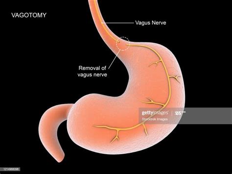 Medical illustration of a vagotomy surgical procedure to remove part... | Medical illustration ...