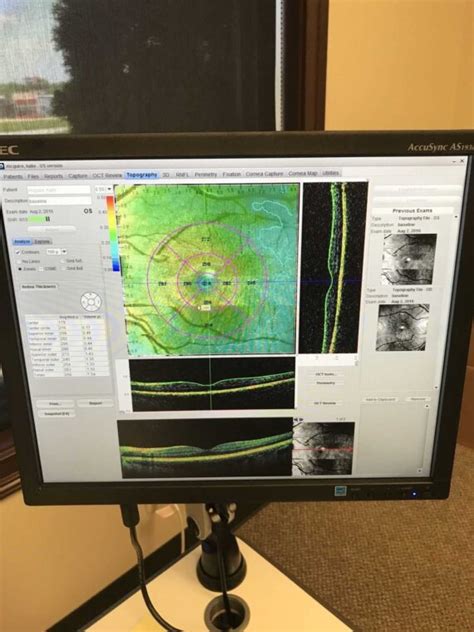 Optos OCT SLO Retina Glaucoma Cornea Analysis - Nava Ophthalmic