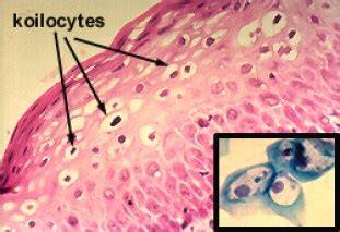 Human PapillomaVirus (HPV) - www.medicoapps.org