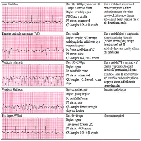 13 Cardiac Rhythm and Dysrhythmias Cheat Sheet Any Nurse Must Know for the Exam - Etsy Australia