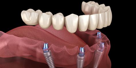 All-on-4 Implants | Fremont | Santa Clara, CA | Teeth in a Day