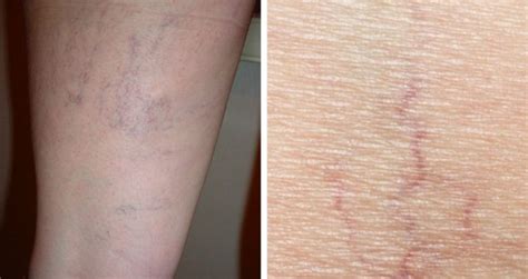 Causes of Spider Veins - Vein Solutions