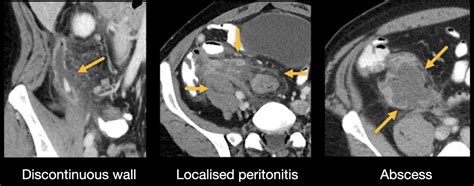 Abdominal CT: appendicitis • LITFL • Radiology Library