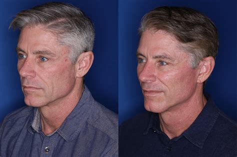 🥇 Atlanta Male Facelift Surgery | Buckhead Male Facelift Surgeon