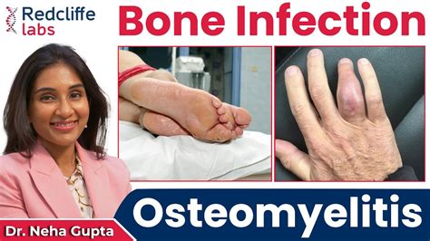 💹 What is Osteomyelitis? Osteomyelitis (Bone Infection) Symptoms ...