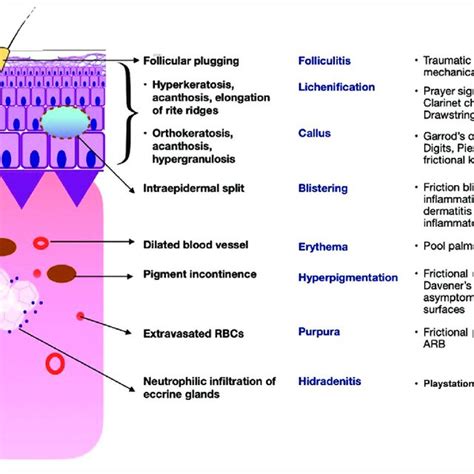 Traumatic anserine folliculosis: Characterised by multiple, closelyset ...