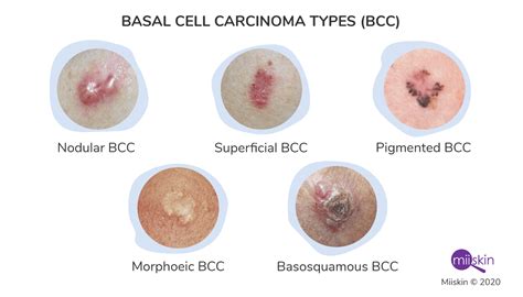 Skin Cancer On Face Early Signs