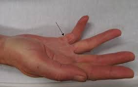 6 Possible Causes of Lump in Palm of Hand Near Ring Finger | New Health ...