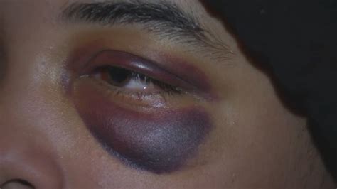 Teen suffers broken eye sockets after brutal attack on Staten Island bus - 6abc Philadelphia