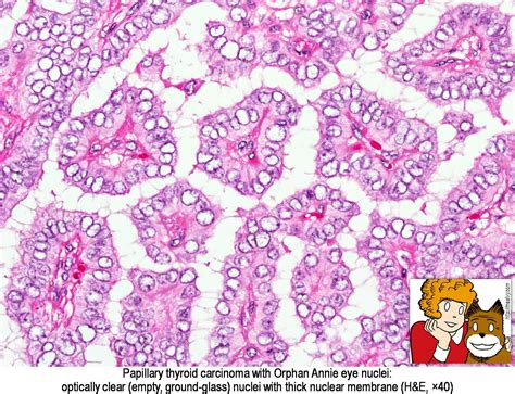 Papillary Thyroid Cancer Orphan Annie Eyes