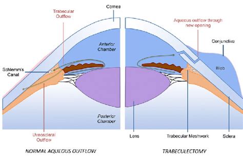 Trabeculectomy — Wollongong Eye Doctor | Ophthalmologist Dr Steven Yun | Illawarra Eye Surgeon