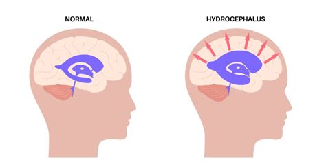 Hydrocephalus | David Berro