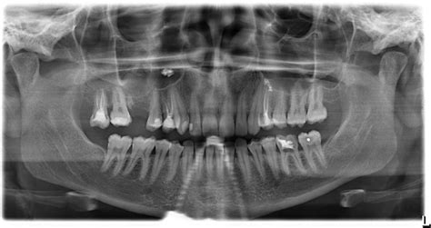 Fungus Ball of the Maxillary Sinus—Modern Treatment by Osteoplastic ...