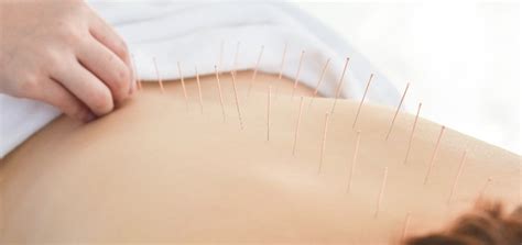 Can Acupuncture Help My Psoriasis? - Kopa for Psoriasis