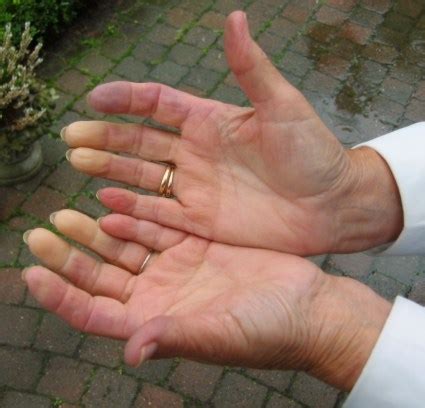 Raynaud's phenomenon - wikidoc