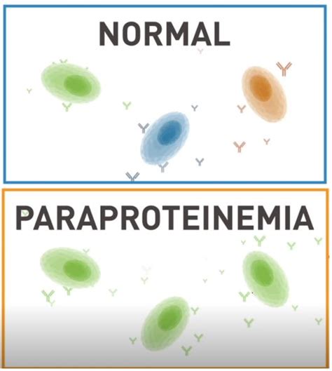 1/ We often check SPEP and/or immunofixation in patients with ...