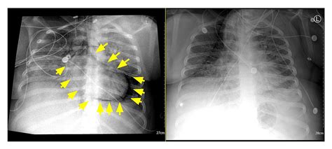 Isolated Pneumopericardium: A Rare Complication Secondary to COVID-19 Infection | Cureus