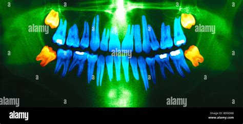 WISDOM TOOTH, X RAY Stock Photo - Alamy