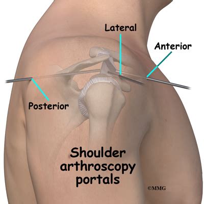 Shoulder Arthroscopy - Orthopedic Surgery, Algonquin, IL, Barrington, IL, Elgin, IL, Geneva, IL