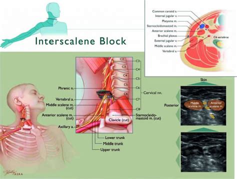 Ultrasound-Guided Interscalene Block : WFSA - Resources