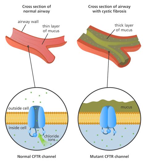 A simple, flat-style illustration to show normal and mutant CFTR ...