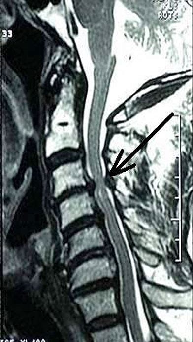 Cervical Central Canal Stenosis | Myelopathy | Spine Specialist