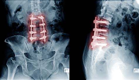 Spinal Fusion Surgery: why it might not fix your lower back pain - 2ser