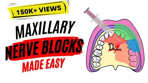 Maxillary Nerve Block