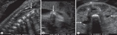 Spina Bifida Ultrasound 20 Weeks