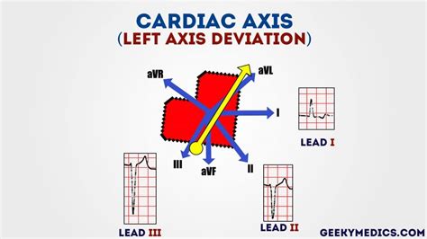 Most Accurate Way to Read a Ekg Strip - Cherry Plicaut