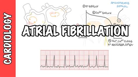 causes of atrial fibrillation hitam - William Forsyth