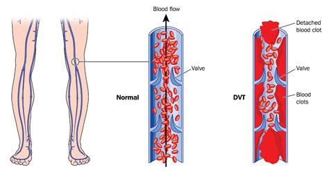 Deep Vein Thrombosis (DVT) - Access Care Vascular - Buffalo, NY