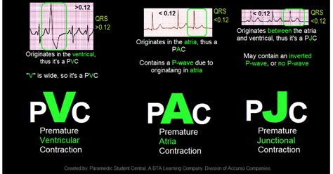 Paramedic Student Central: PVC, PAC, PJC Quick Reference Tool