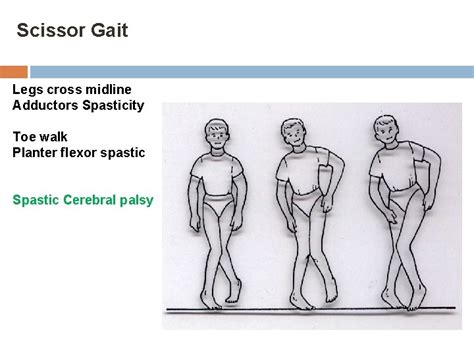 ABNORMAL GAIT Abnormal Gait Syndromes In general gait