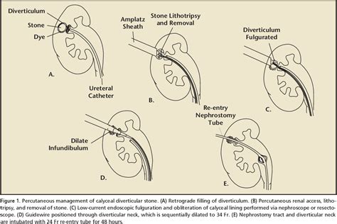 Calyceal diverticula: a comprehensive review. | Semantic Scholar