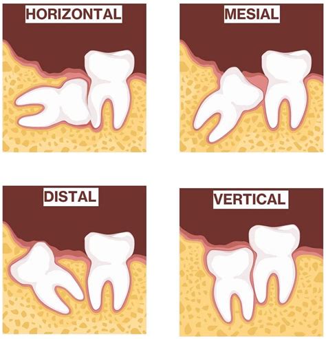 Painless Wisdom Tooth Extraction - Singapore Dental Clinic